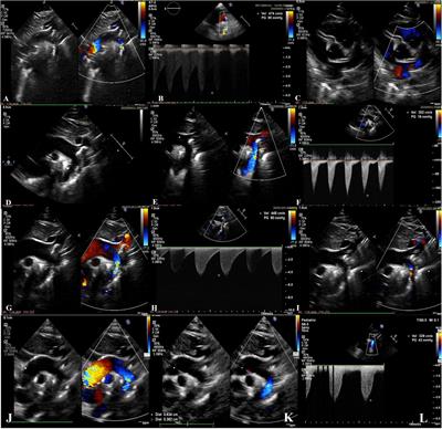Severe early-onset manifestations of generalized arterial calcification of infancy (mimicking severe coarctation of the aorta) with ABCC6 gene variant — Case report and literature review